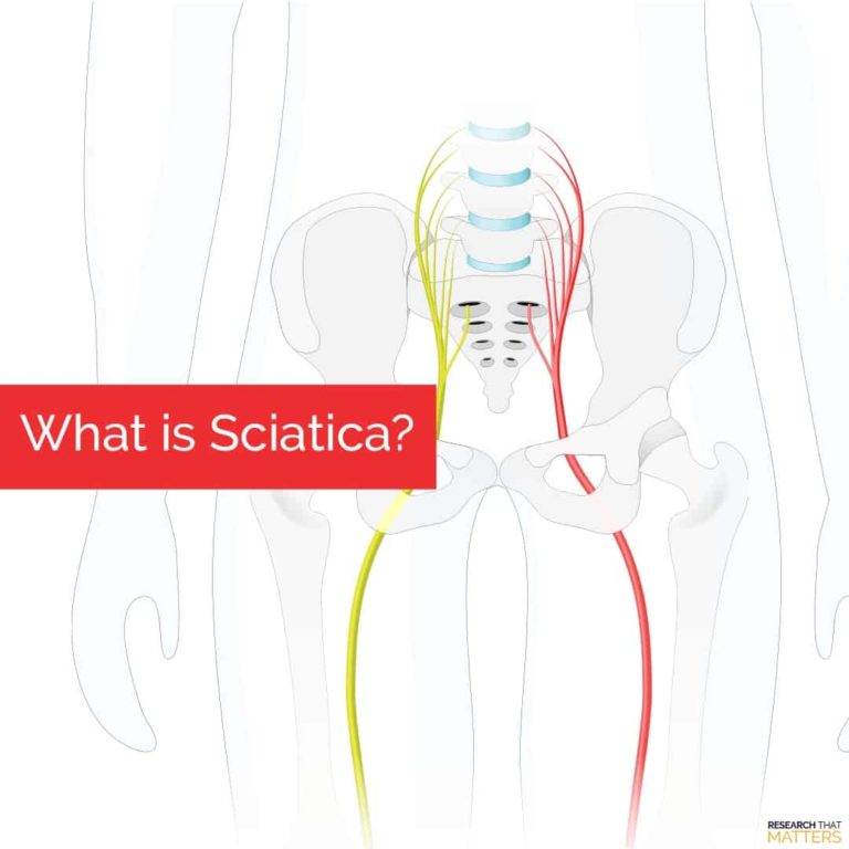 Week What is Sciatica
